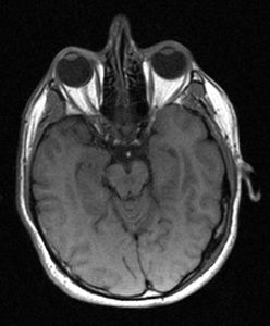 Linac-MR T1 trasverse view of head
