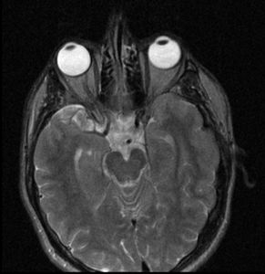 Linac-MR T2 trasverse view of head.